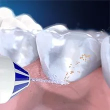 A close-up simulated view of toothpaste or treatment being applied to teeth with brown specks near the gum line.